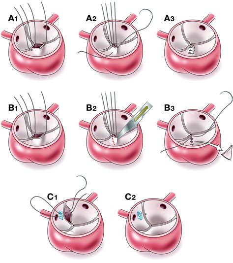 Outcomes of aortic valve repair in children resulting in .